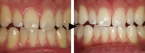 ホワイトニング