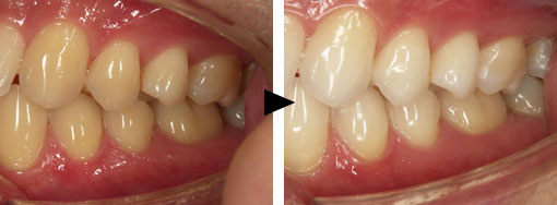 ホワイトニング