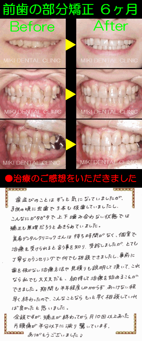 完成　前歯の部分矯正　６ヶ月.gif